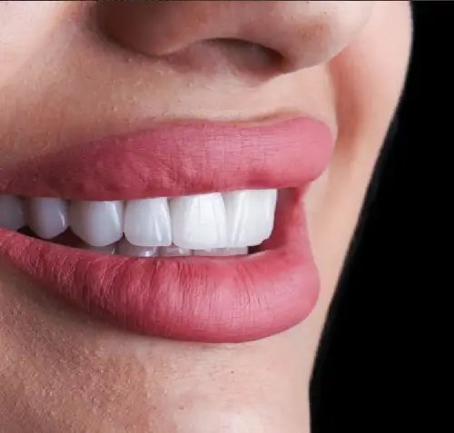 Hollywood Smile