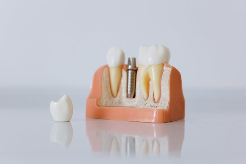 Single Implant Dental Treatment
